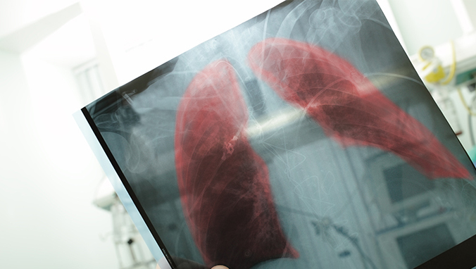 Is peripheral lung cancer 2 cm late?