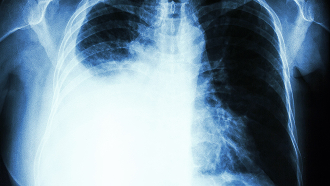 Is the white shadow of the lungs cancer?